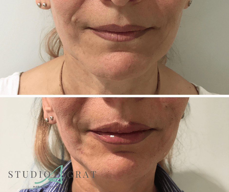 Filler Viso Acido Ialuronico