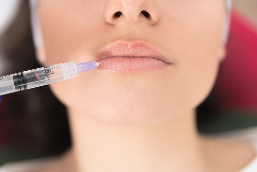Filler Labbra Acido Ialuronico