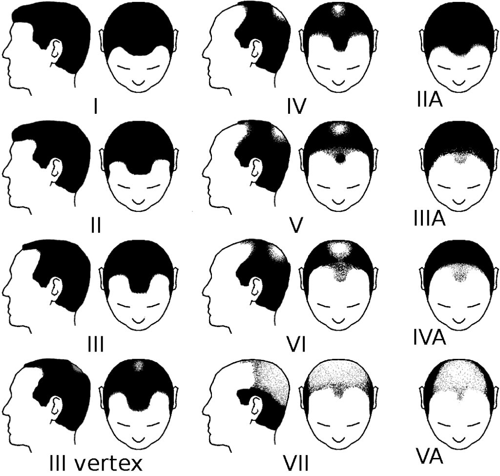 Quali sono i tipi di calvizie e alopecia e come curarle con lo Studio Medico Adigrat di Milano - Scala di Hamilton-Norwood