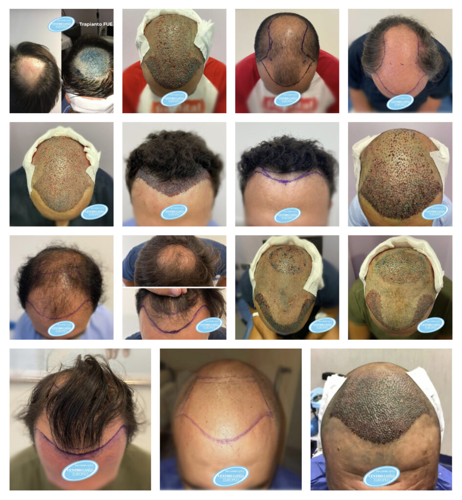 Esempi di Trapianto Capelli con tecnica FUE effettuati dal nostro partner Centro Capelli Europeo