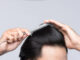 trapianto di capelli