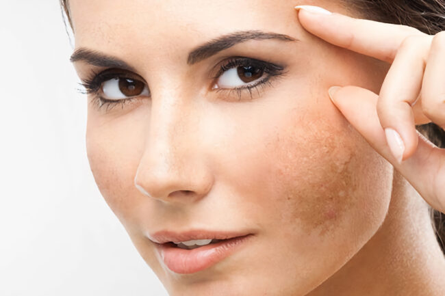 Blog Post - macchie della pelle - cosa fare con la medicina estetica?