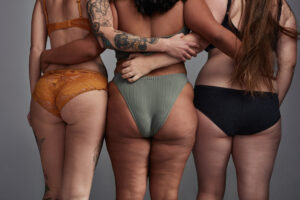 Blog Post - come combattere la cellulite
