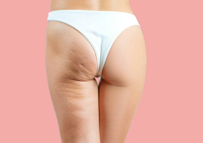 trattamenti-corpo-anticellulite-milano Trattamenti corpo anticellulite a Milano