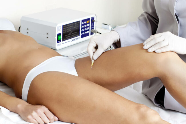 Blog Post – Carbossiterapia La carbossiterapia, l'alleato perfetto contro la cellulite e non solo