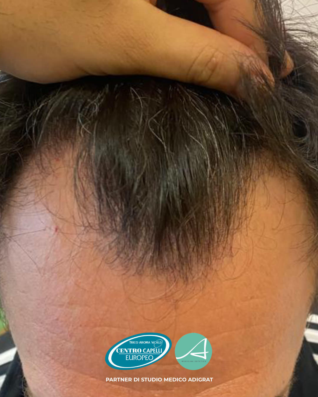 Foto testimonianza del prima di un trapianto capelli FUE effettuato dallo Studio Medico Adigrat con il Centro Capelli Europeo a Milano