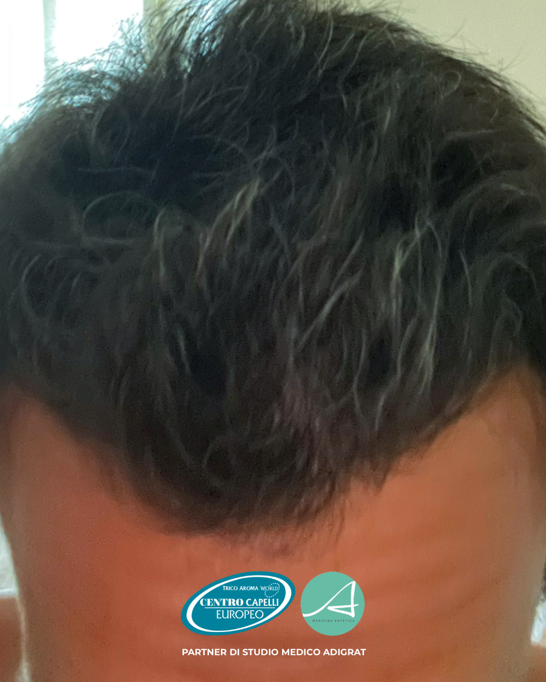 Foto testimonianza del dopo di un trapianto capelli FUE effettuato dallo Studio Medico Adigrat con il Centro Capelli Europeo a Milano