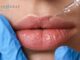 filler labbra