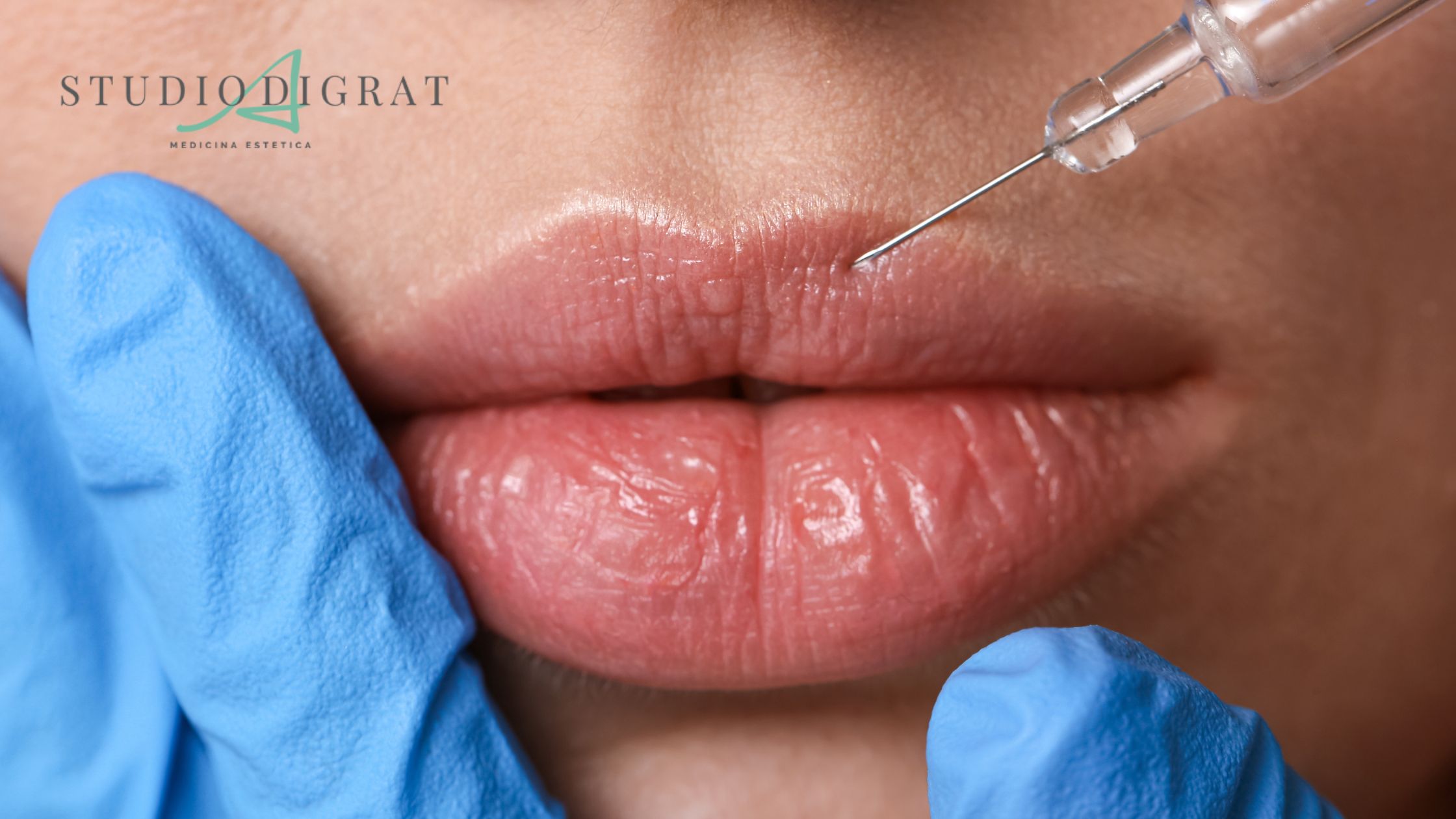 filler labbra filler labbra