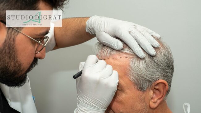 trapianto FUE Milano trapianto FUE Milano