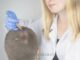 Trattamenti per la cura dell’alopecia